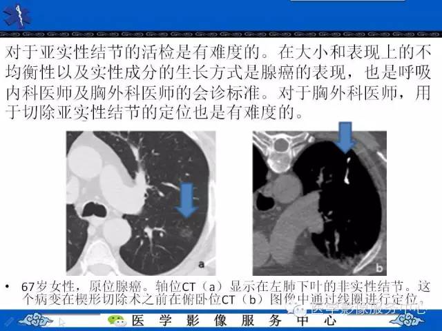 【PPT】亚实性肺结节—影像诊断医师和临床医师必知内容