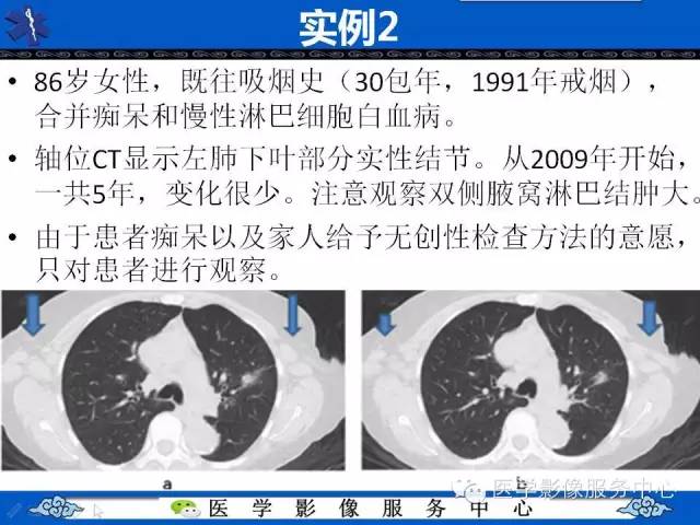 【PPT】亚实性肺结节—影像诊断医师和临床医师必知内容
