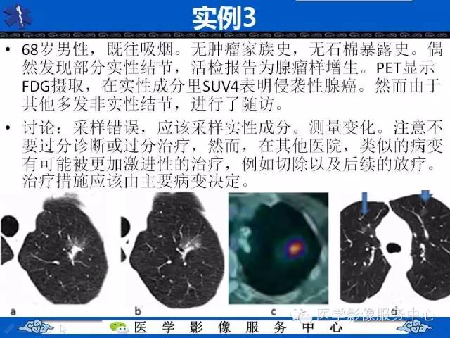 【PPT】亚实性肺结节—影像诊断医师和临床医师必知内容