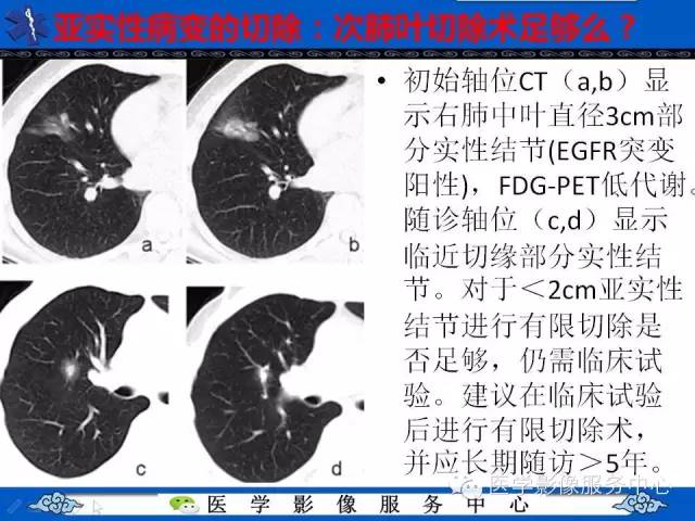 【PPT】亚实性肺结节—影像诊断医师和临床医师必知内容