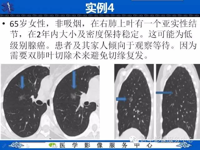 【PPT】亚实性肺结节—影像诊断医师和临床医师必知内容
