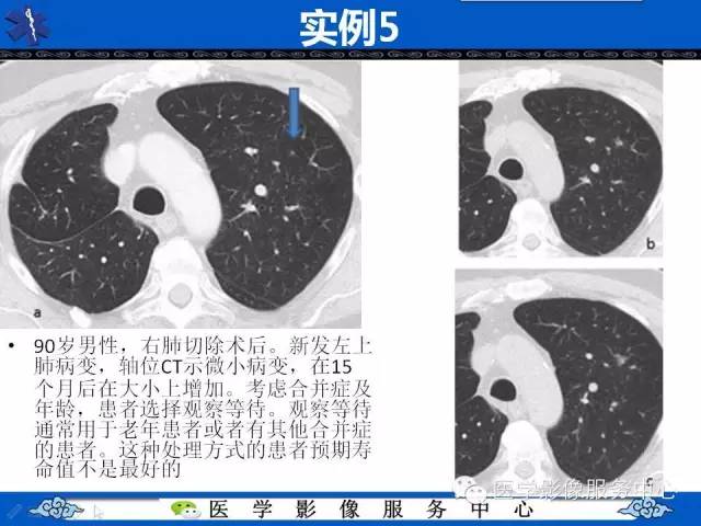 【PPT】亚实性肺结节—影像诊断医师和临床医师必知内容