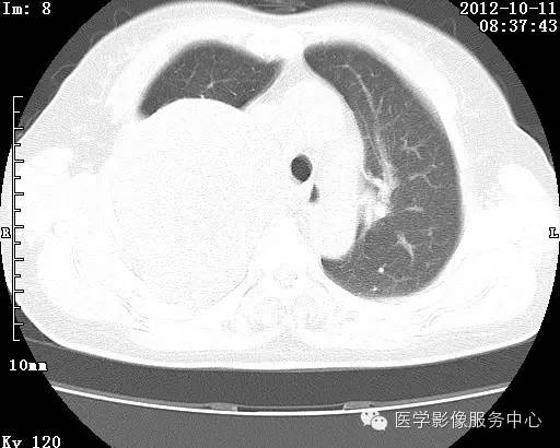【病例】右肺巨大错构瘤1例CT影像表现