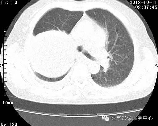 【病例】右肺巨大错构瘤1例CT影像表现