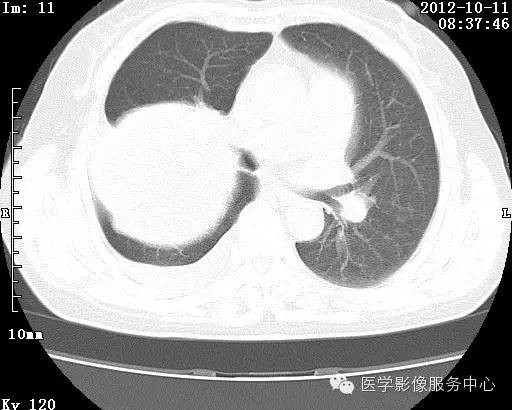 【病例】右肺巨大错构瘤1例CT影像表现