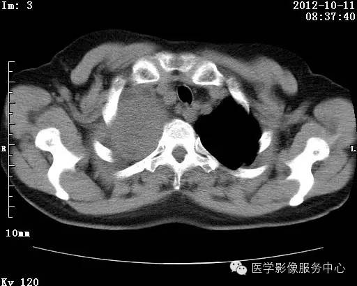 【病例】右肺巨大错构瘤1例CT影像表现