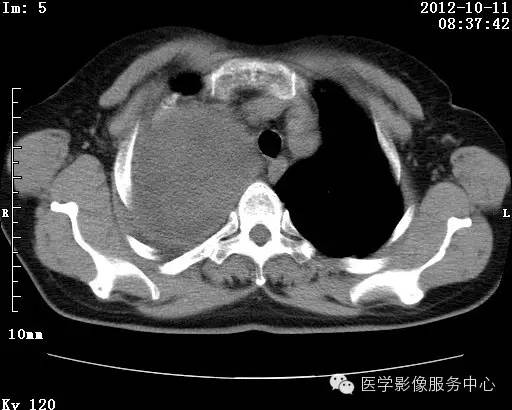 【病例】右肺巨大错构瘤1例CT影像表现