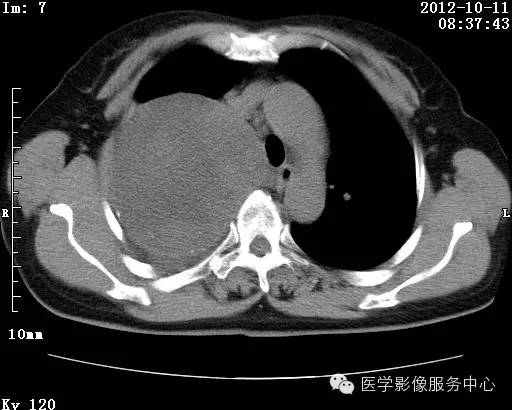 【病例】右肺巨大错构瘤1例CT影像表现