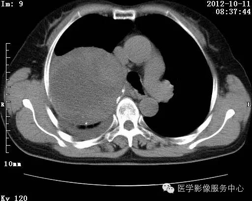 【病例】右肺巨大错构瘤1例CT影像表现