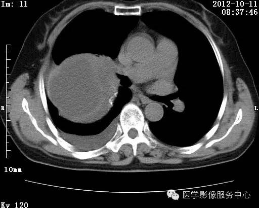 【病例】右肺巨大错构瘤1例CT影像表现