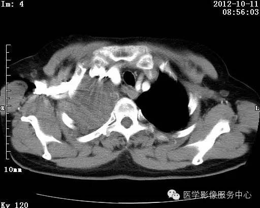 【病例】右肺巨大错构瘤1例CT影像表现