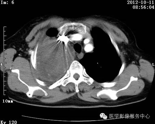【病例】右肺巨大错构瘤1例CT影像表现