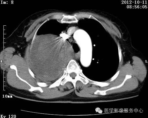 【病例】右肺巨大错构瘤1例CT影像表现