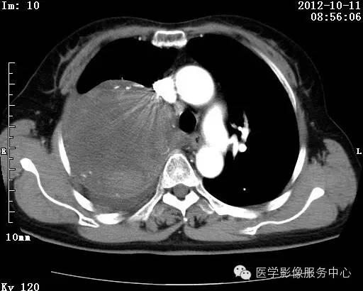 【病例】右肺巨大错构瘤1例CT影像表现