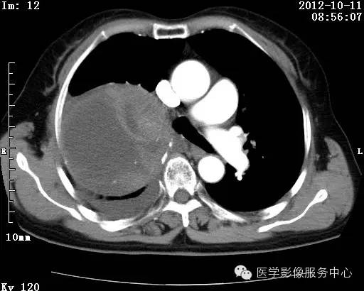 【病例】右肺巨大错构瘤1例CT影像表现