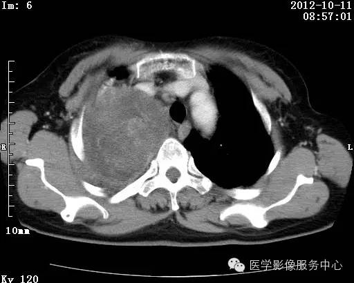 【病例】右肺巨大错构瘤1例CT影像表现