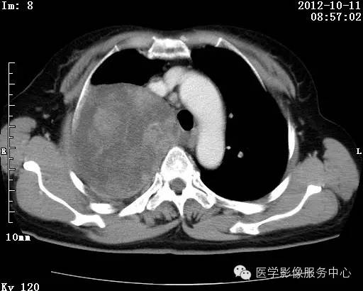 【病例】右肺巨大错构瘤1例CT影像表现