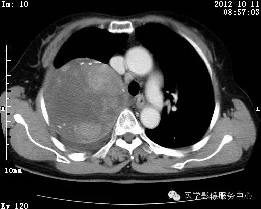 【病例】右肺巨大错构瘤1例CT影像表现