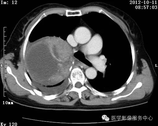 【病例】右肺巨大错构瘤1例CT影像表现