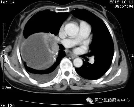 【病例】右肺巨大错构瘤1例CT影像表现