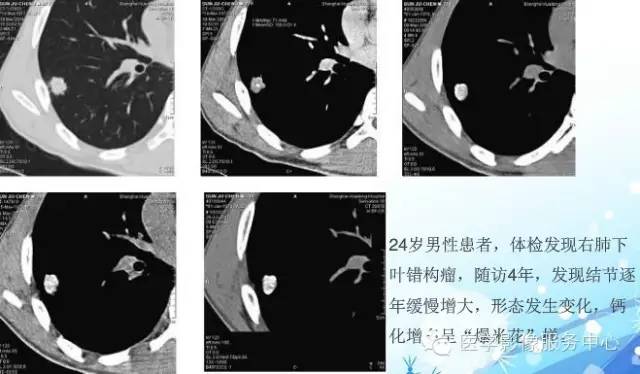 【病例】右肺巨大错构瘤1例CT影像表现