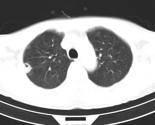 【病例】金黄色葡萄球菌肺炎1例CT影像表现