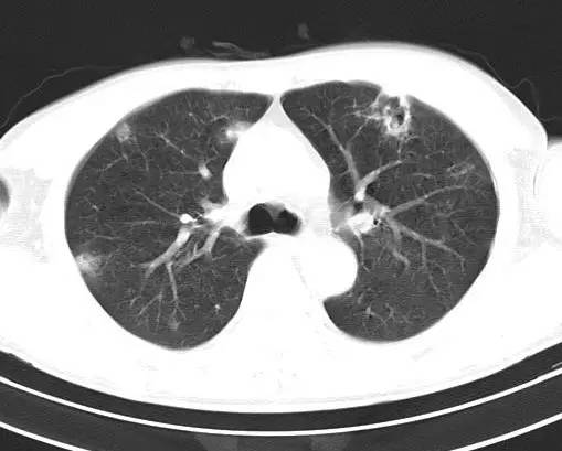 【病例】金黄色葡萄球菌肺炎1例CT影像表现