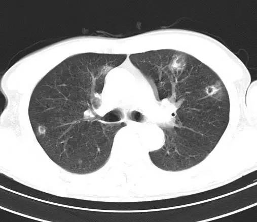 【病例】金黄色葡萄球菌肺炎1例CT影像表现
