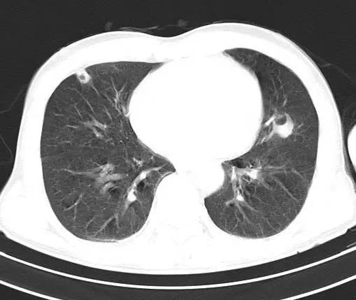 【病例】金黄色葡萄球菌肺炎1例CT影像表现