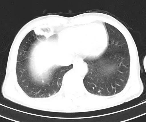 【病例】金黄色葡萄球菌肺炎1例CT影像表现