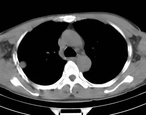 【病例】金黄色葡萄球菌肺炎1例CT影像表现