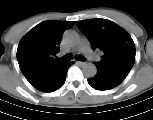 【病例】金黄色葡萄球菌肺炎1例CT影像表现