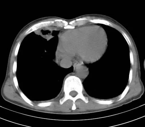 【病例】金黄色葡萄球菌肺炎1例CT影像表现