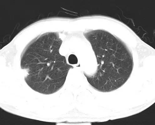 【病例】金黄色葡萄球菌肺炎1例CT影像表现