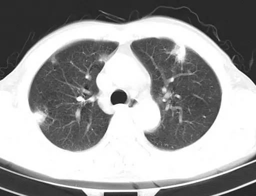 【病例】金黄色葡萄球菌肺炎1例CT影像表现