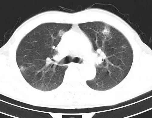 【病例】金黄色葡萄球菌肺炎1例CT影像表现