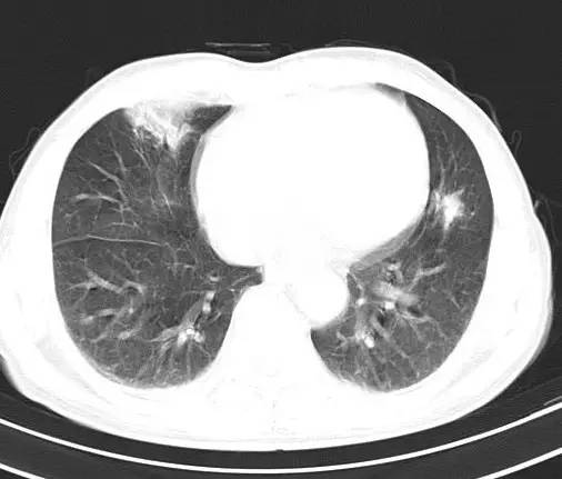 【病例】金黄色葡萄球菌肺炎1例CT影像表现