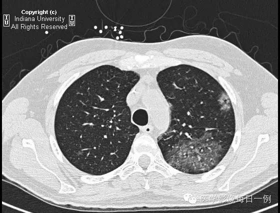 【病例】肺泡性出血1例X线 CT影像表现