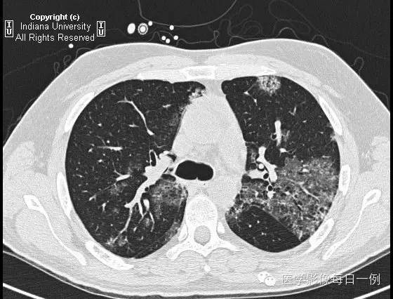 【病例】肺泡性出血1例X线 CT影像表现