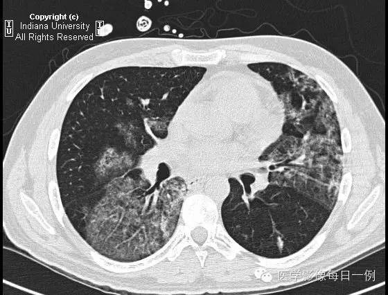 【病例】肺泡性出血1例X线 CT影像表现