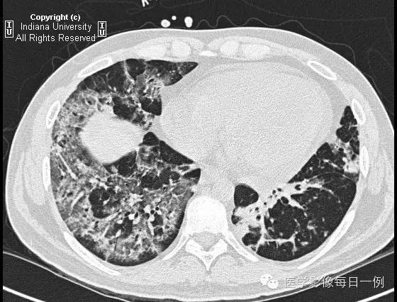 【病例】肺泡性出血1例X线 CT影像表现