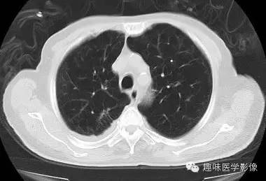 【病例】肺脓肿1例CT影像特点