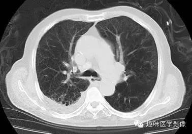 【病例】肺脓肿1例CT影像特点