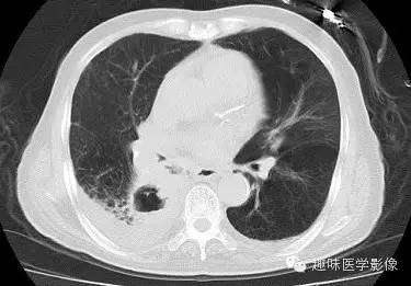 【病例】肺脓肿1例CT影像特点