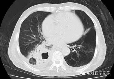 【病例】肺脓肿1例CT影像特点