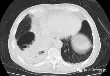 【病例】肺脓肿1例CT影像特点