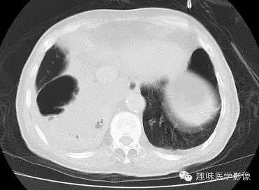 【病例】肺脓肿1例CT影像特点