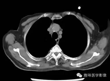【病例】肺脓肿1例CT影像特点
