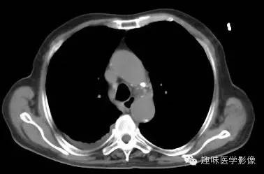 【病例】肺脓肿1例CT影像特点