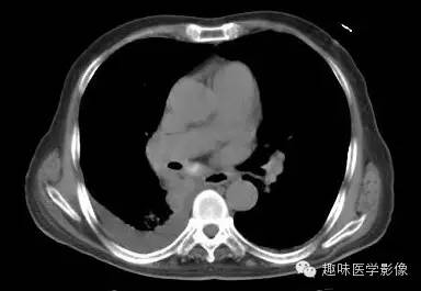 【病例】肺脓肿1例CT影像特点